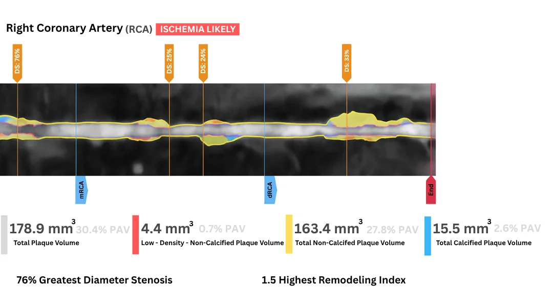 Actual AI-enhanced scan of the right coronary artery — plaque volumes quantified down to a tenth of a cubic millimeter. This is what most cardiologists never look at. And this is what causes most heart attacks.